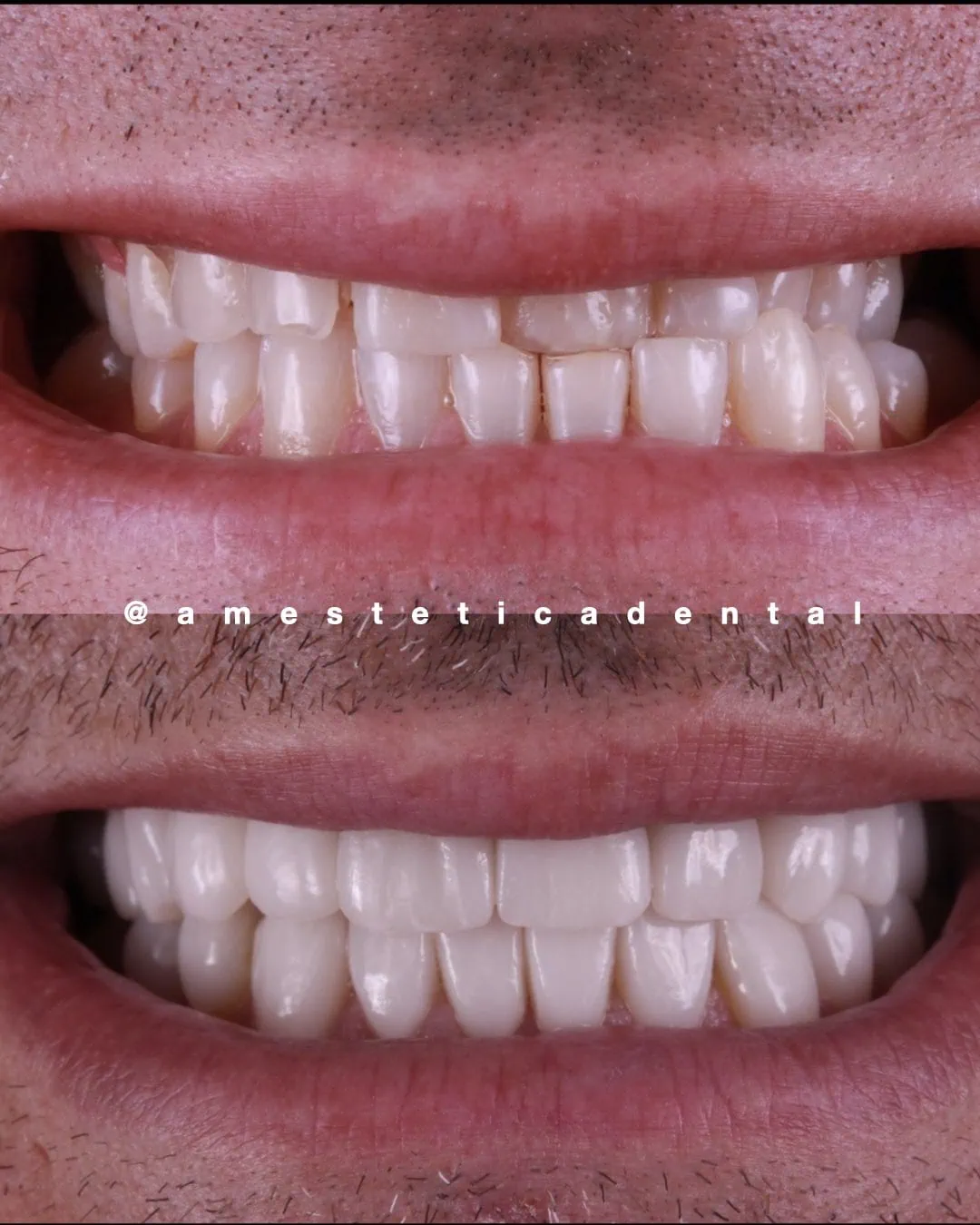 Tratamiento de bruxismo con carillas y corrección de mordida cruzada — AM Estética Dental