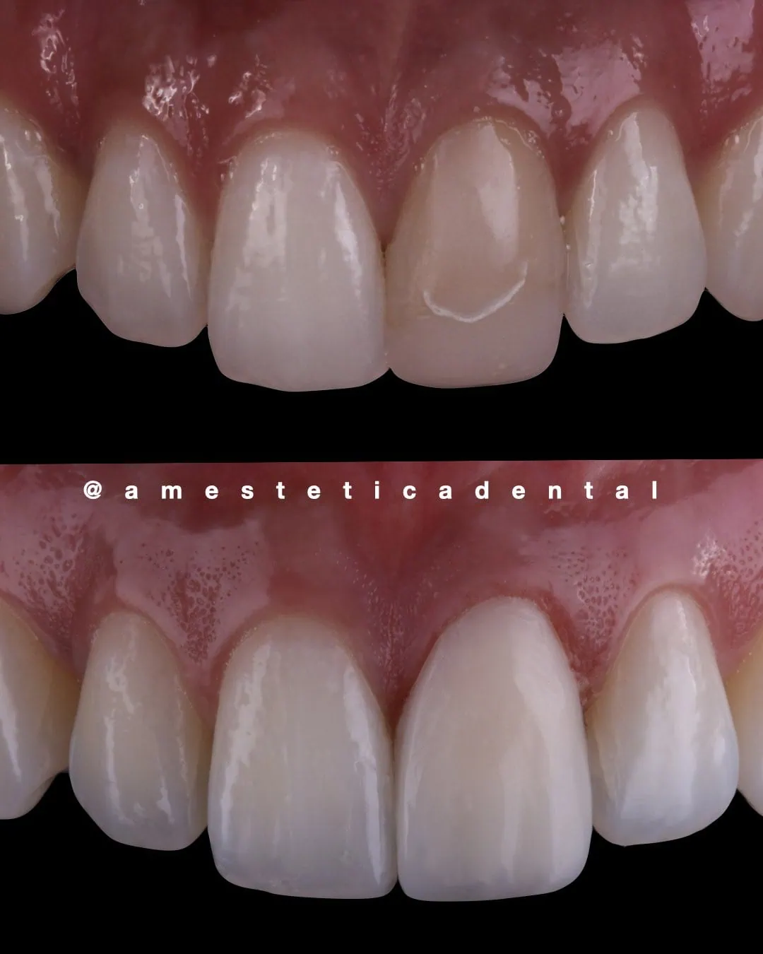 Carilla sobre diente oscurecido post tratamiento de conducto — AM Estética Dental