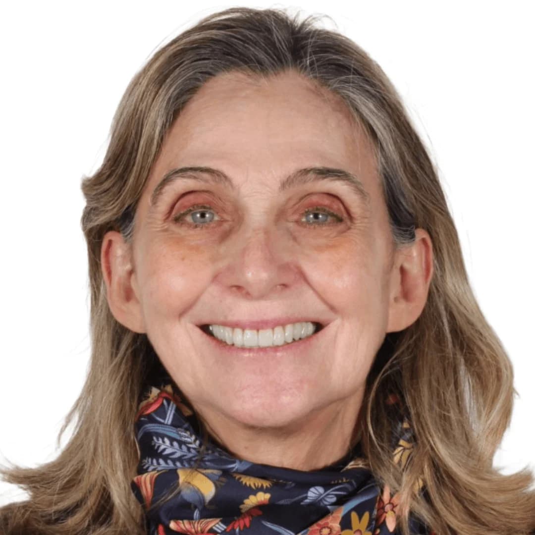 Antes y después de carillas cerámicas — AM Estética Dental