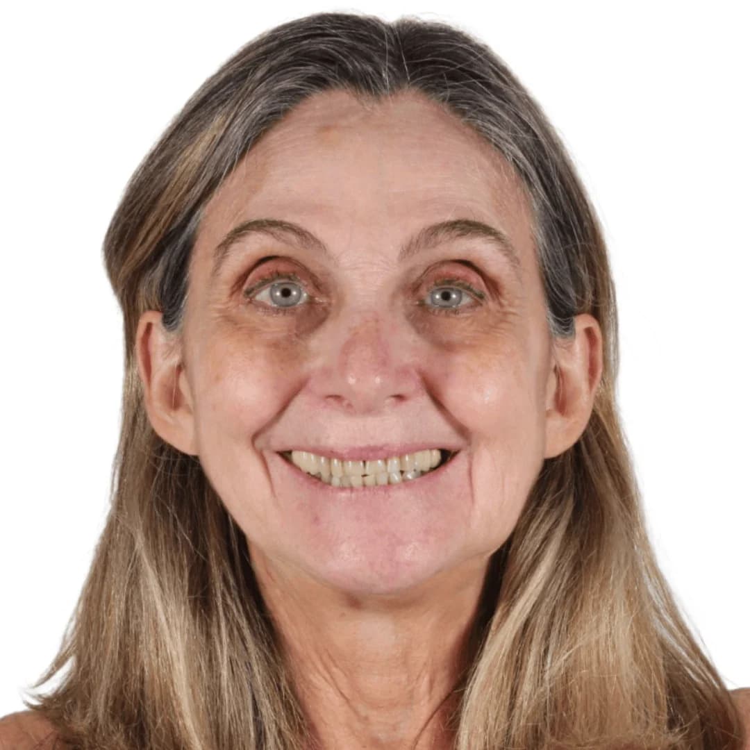 Carillas cerámicas antes y después — AM Estética Dental Puerto Madero