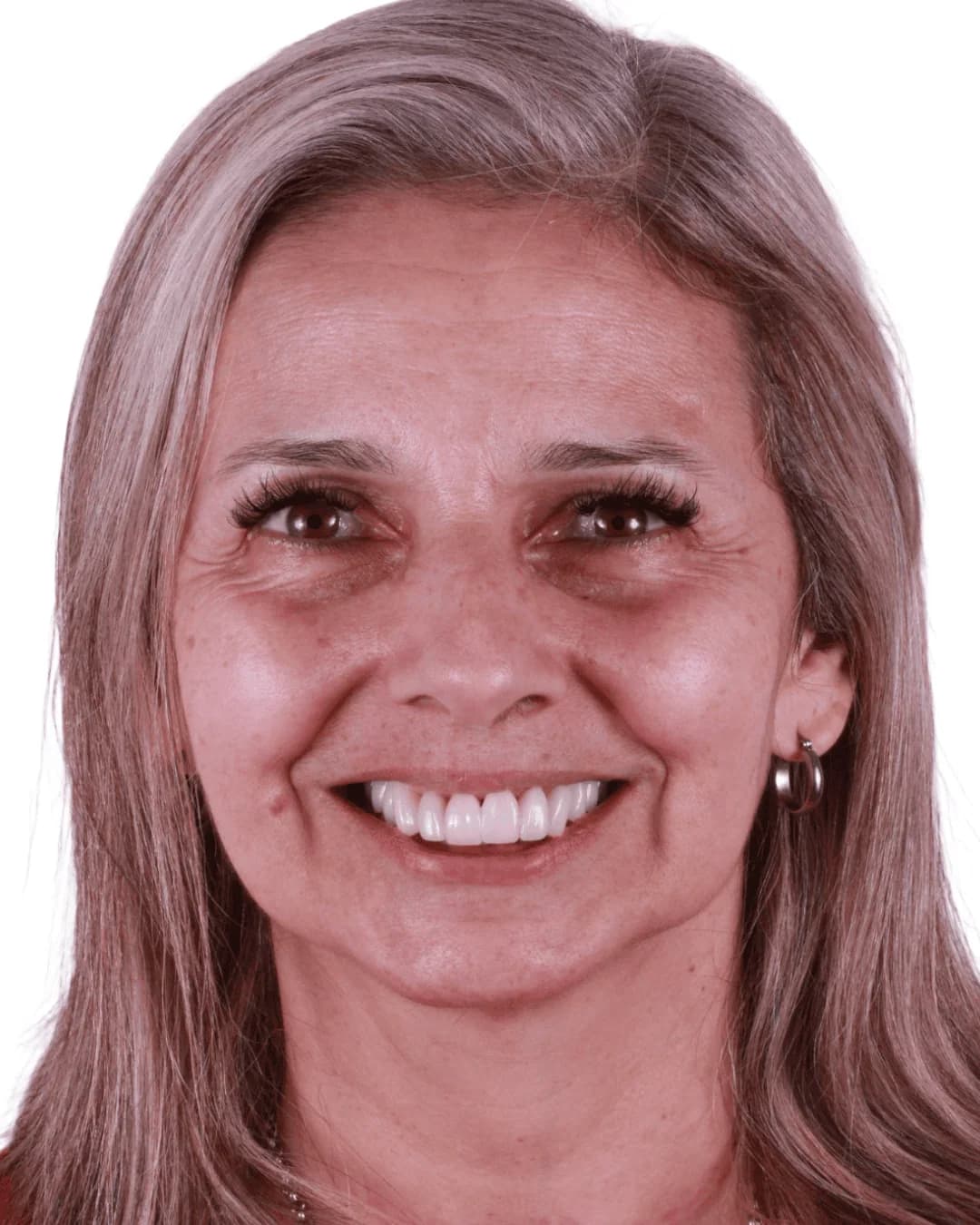 Carillas cerámicas caso avanzado antes y después — AM Estética Dental