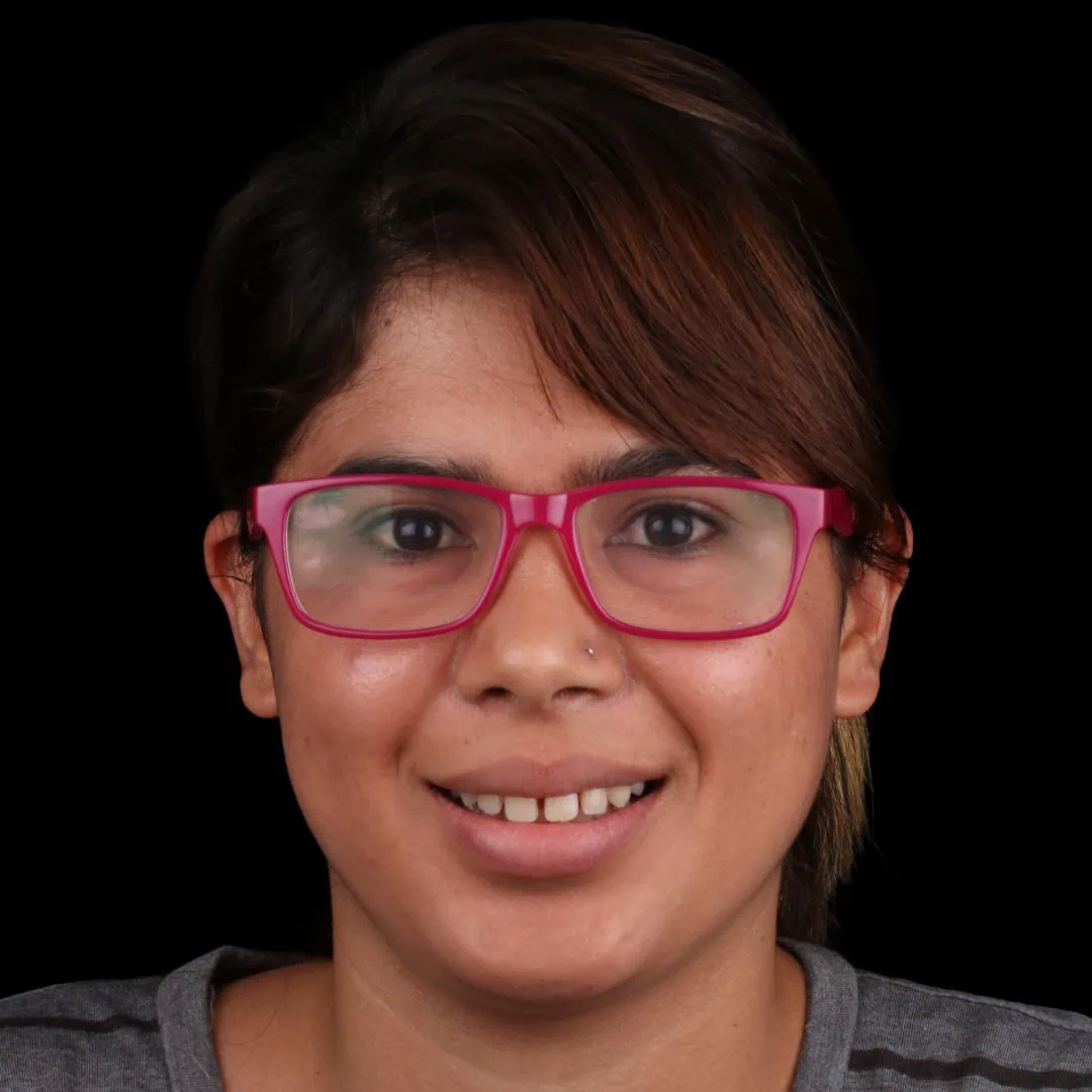 Caso Eli — antes del tratamiento con carillas cerámicas — AM Estética Dental