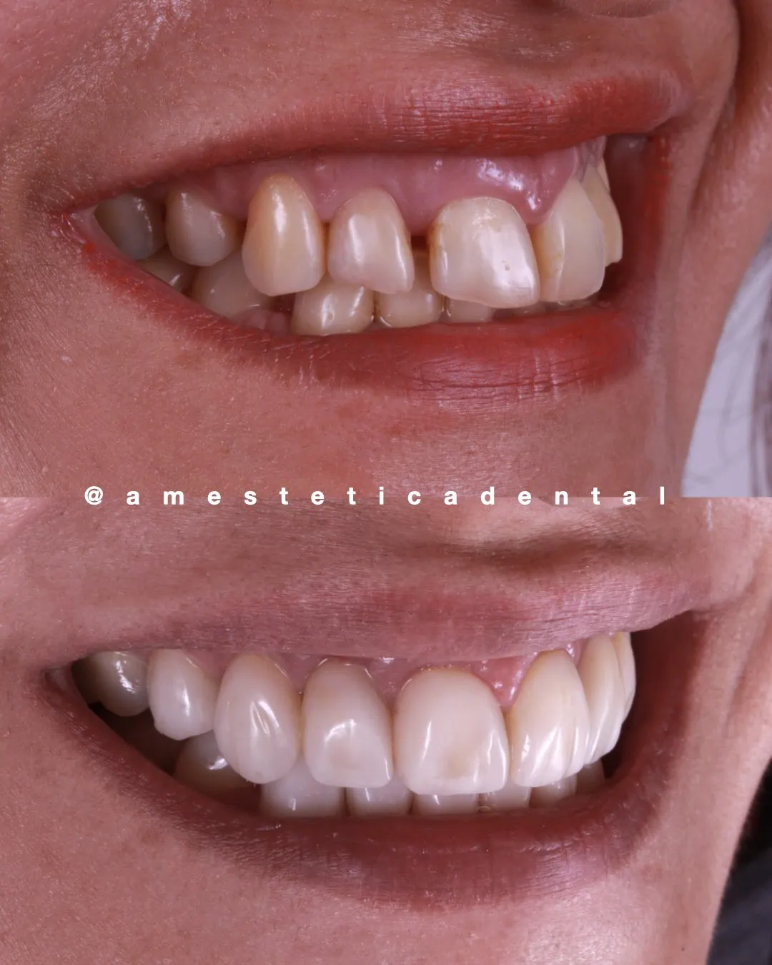 Tratamiento de erosión dentaria con carillas cerámicas — AM Estética Dental