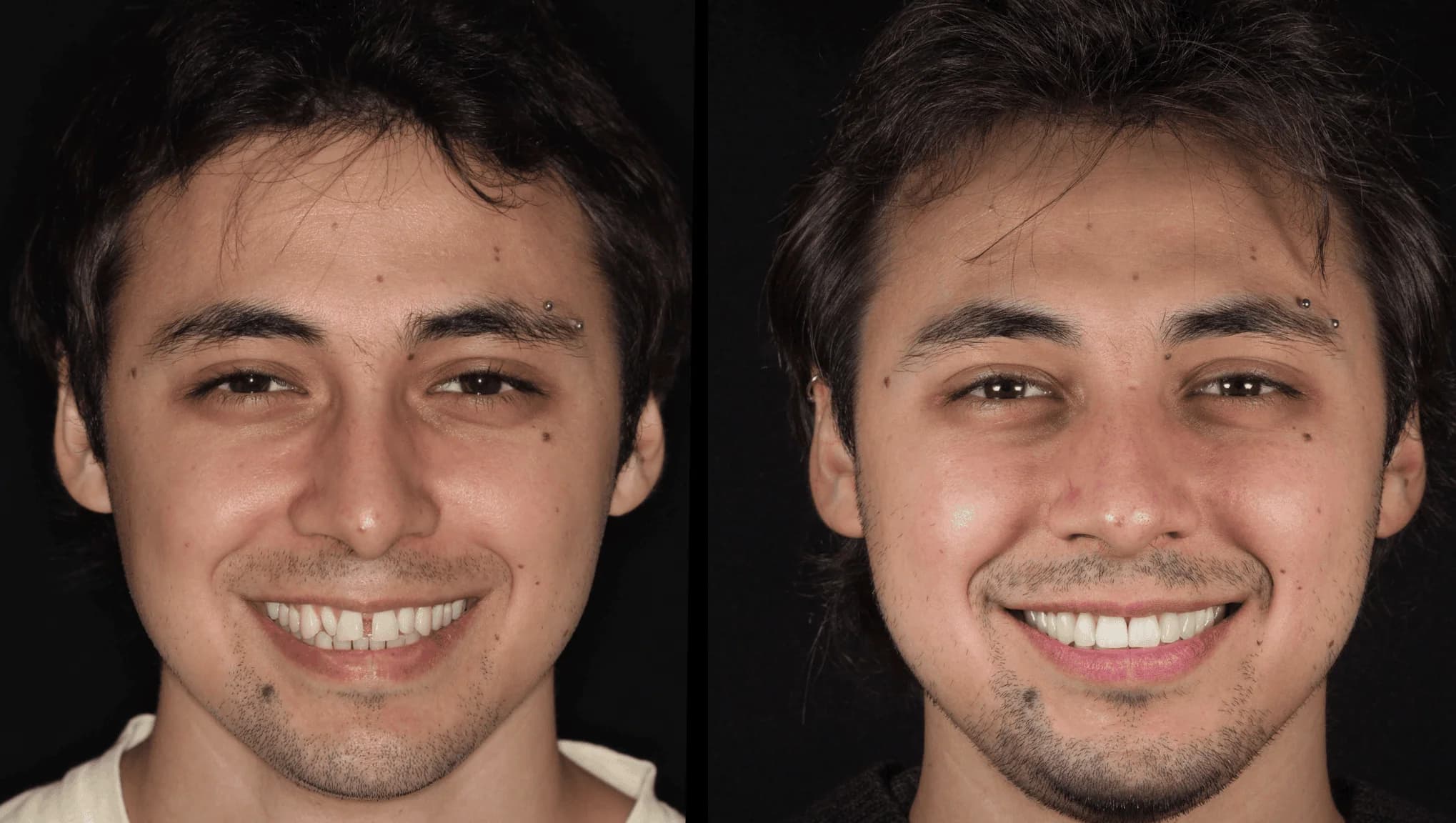 Transformación extrema con carillas de porcelana — Dr. Ariel Merino — AM Estética Dental Puerto Madero