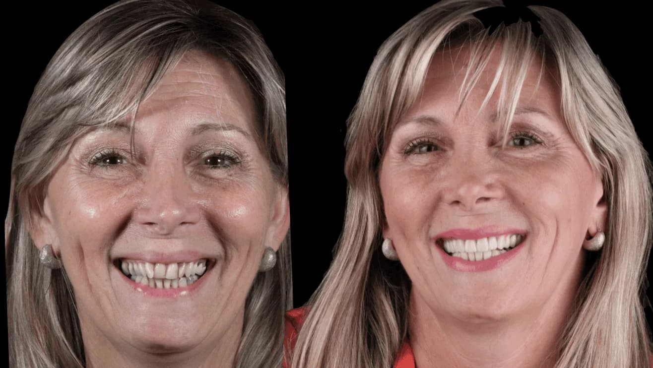 Transformación extrema con carillas — antes y después — Dr. Ariel Merino AM Estética Dental