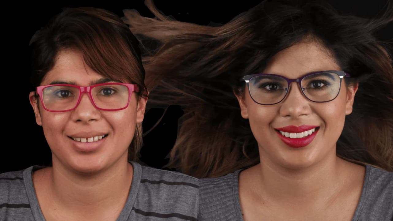 Caso extremo de diseño de sonrisa con carillas cerámicas — Dr. Ariel Merino