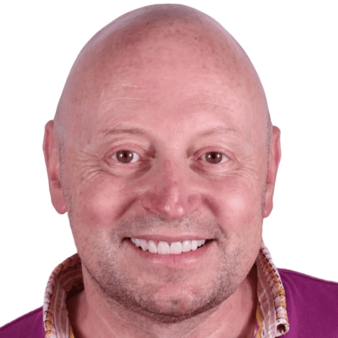 Resultado carillas cerámicas caso internacional — AM Estética Dental