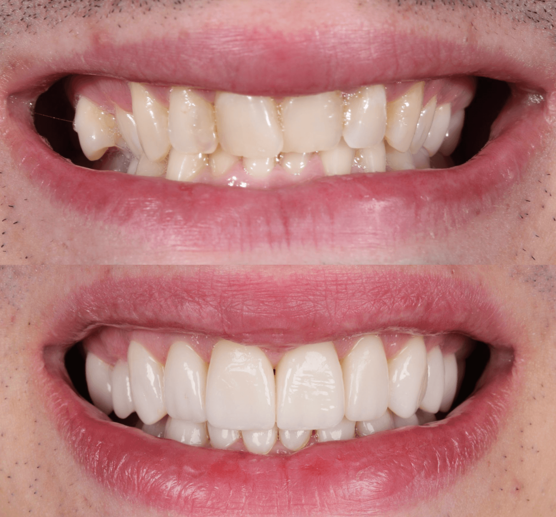 Antes y después diseño de sonrisa con 20 carillas de porcelana sin ortodoncia — AM Estética Dental