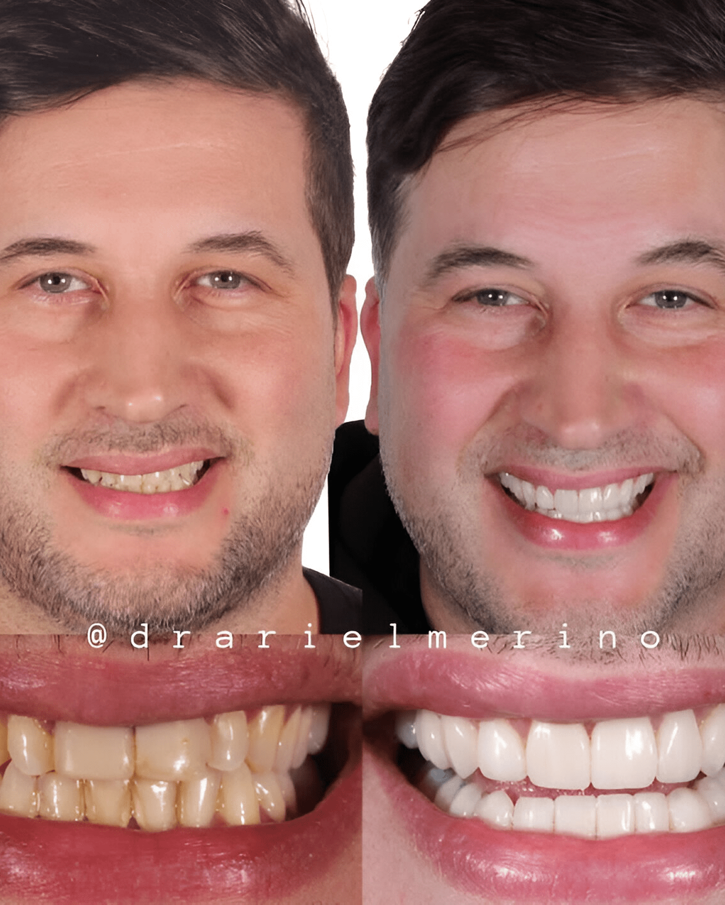 antes-despues2 1 (1)